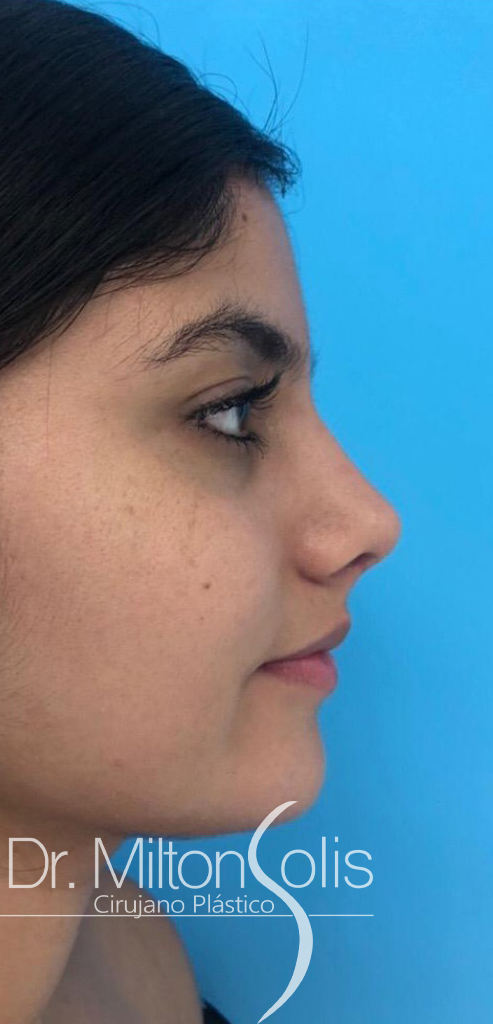 Rinoplastia/ Después