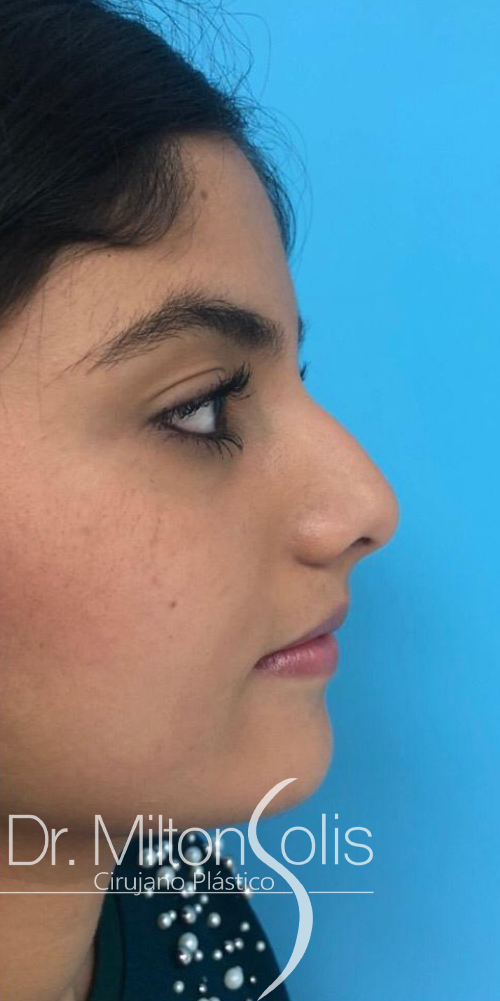 Rinoplastia / Antes