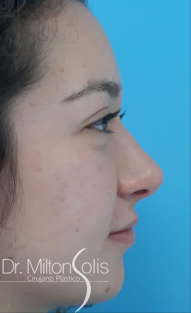 Rinoplastia