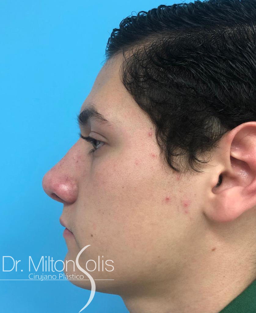 Rinoplastia/ Después
