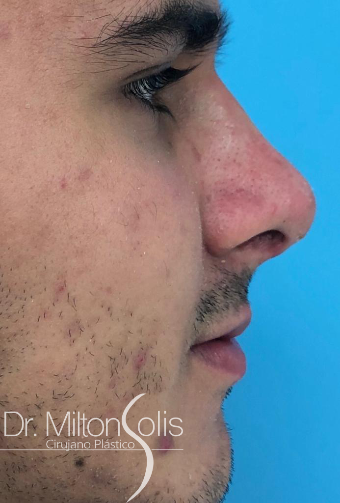 Rinoplastia/ después
