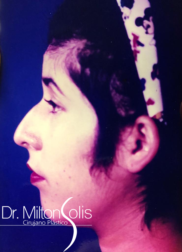 Rinoplastia / Antes