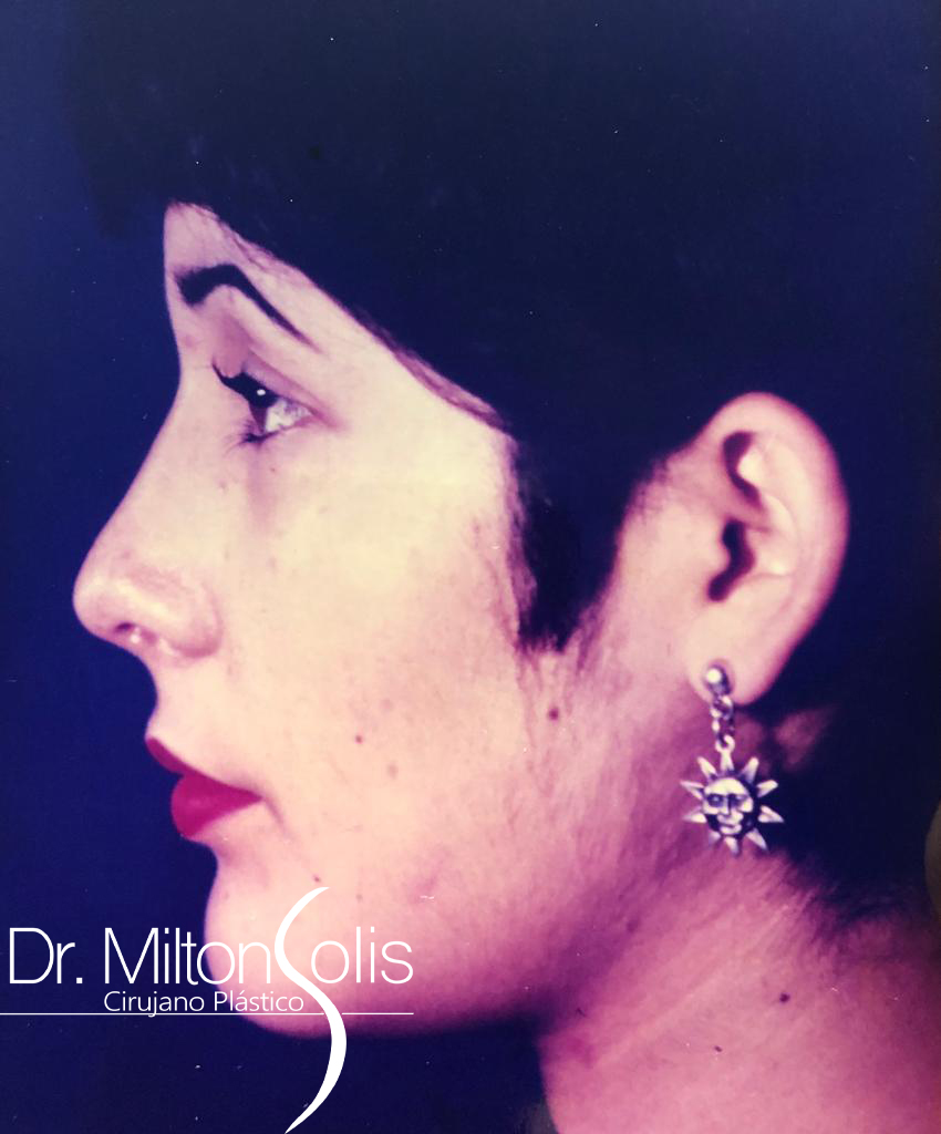 Rinoplastia/ Después
