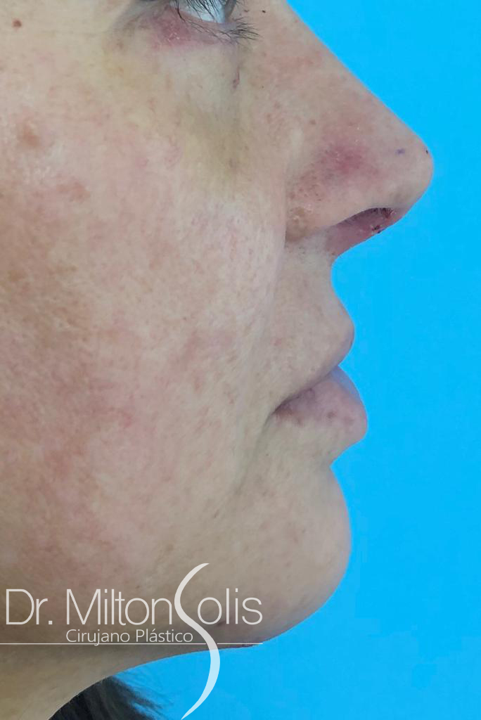 Rinoplastia / Después