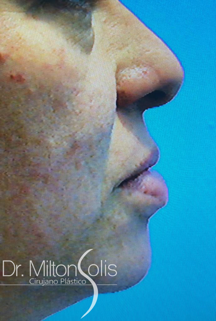 Rinoplastia / Antes